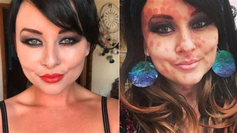 Woman Develops Incurable Skin Condition After New Years Eve Kiss