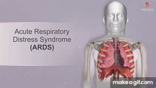 Acute Respiratory Distress Syndrome ARDS Etiology Clinical