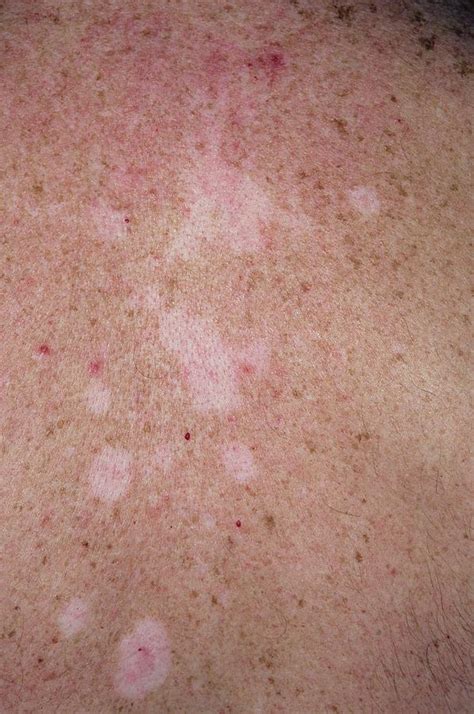 Pityriasis Versicolor Photograph By Dr P Marazzi Science Photo Library My Xxx Hot Girl