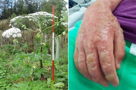 Giant Hogweed Warning As Baby Left With Raw Burns After Sisters