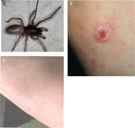 Wolf Spider Bite Information