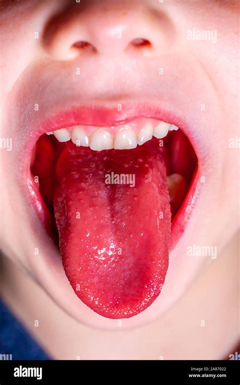 Tongue Of A Child With Scarlet Fever Strawberry Tongue Stock Photo