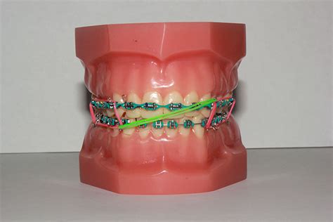 Elastics Orthodontic Specialists