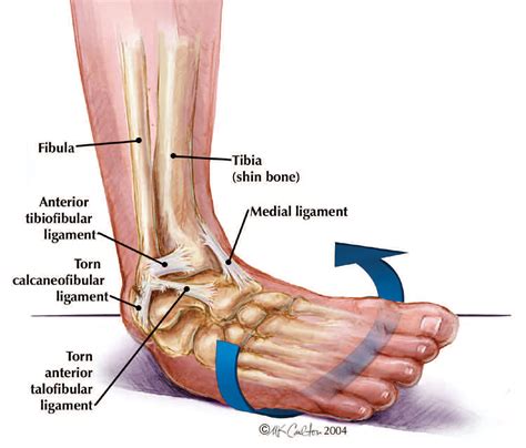 Ankle Sprains The Institute For Athletic Medicine