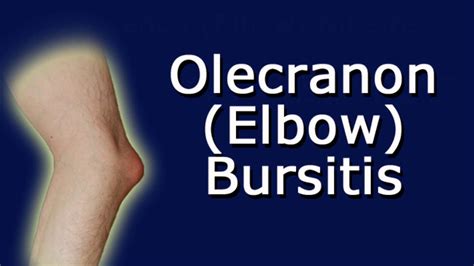 Olecranon Elbow Bursitis Youtube