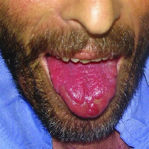 Photograph Of The Patients Tongue Showing Nodular Lesions With Areas