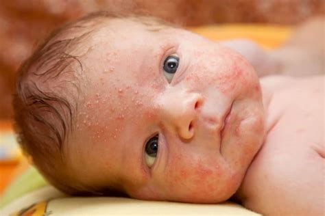 Newborn Baby Skin Problems Skin