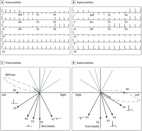 Influence Of Prone Positioning On Electrocardiogram In A Patient With