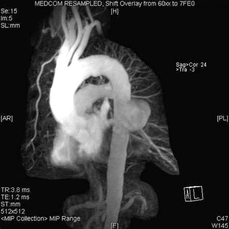 Ruptured Thoracic Aortic Aneurysm From Listeria Monocytogenes Aortitis