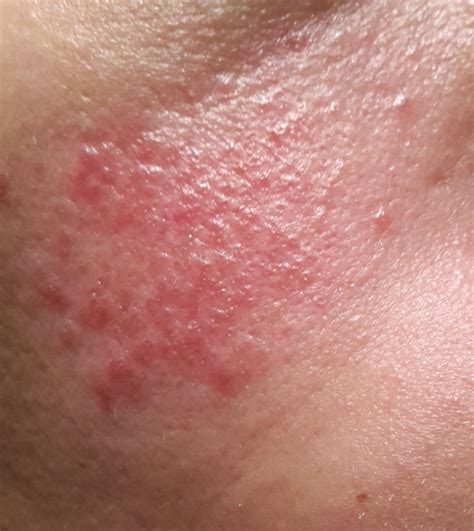 Die pickel sind jedesmal schnell abgeklungen und auch größere, tiefer unter der haut sitzende akne wurde ich schneller los. Rote Flecken im Gesicht was kann ich tun? (Gesundheit, Beauty)