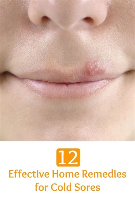 12 effective home remedies for cold sores selfcarers cold home remedies cold sore natural