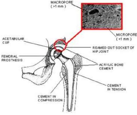 Schematic View Of Total Hip Replacement 3 Download Scientific Diagram