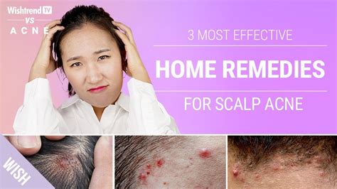How To Get Rid Of Scalp And Back Of Neck Acne Naturally 3 Most
