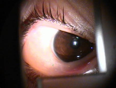 Take Care Of Your Eyes Conjunctival Chemosis