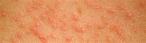 Hiv Rashes On Face