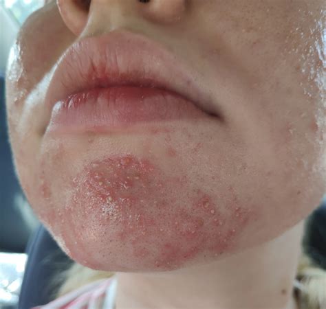 From Fungal Acnefolliculitis To Clear Skin With Pictures Skin Careless