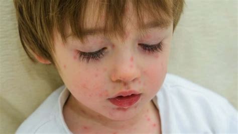 What You Need To Know About Scarlet Fever You Are Mom
