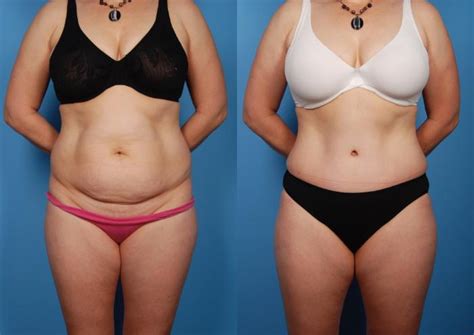 Tummy Tuck Before And After Photo Gallery Toronto On Ford Plastic