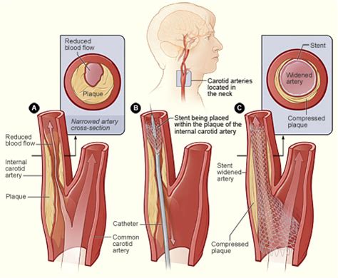The common carotid artery sometimes follows a very tortuous course, forming one or more distinct loops in the neck. Carotid artery disease. Causes, symptoms, treatment Carotid artery disease