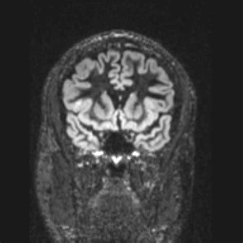 Cortical Dysplasia With Balloon Cells Pacs