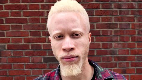 Albinismus Weltweit Größte Albino Familie Besteht Aus 15 Briten Stern De