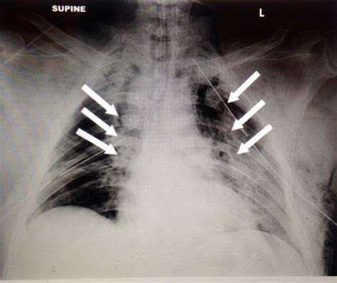 Rib Fractures Causing Flail Chest Suspect This In Patients With