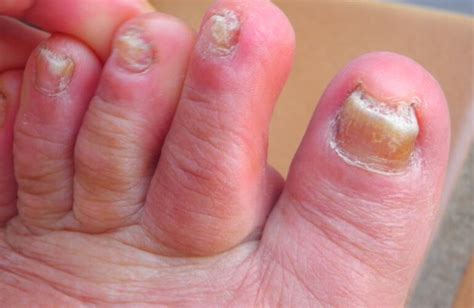 Toenail Fungus Pictures Treatment Home Remedies And Medication