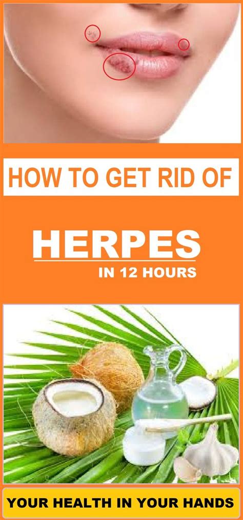 home remedy to getting rid of herpes in 12 hours wellness webs