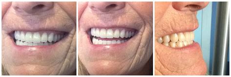 Immediate Complete Upper And Lower Dentures Kelowna Denture Clinic