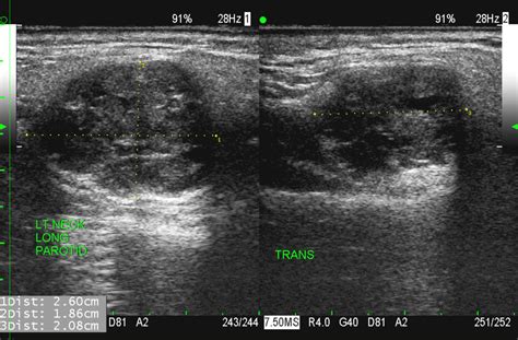 Parotid Gland Tumor Ultrasound