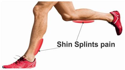 Shin Splints Common Causes Symptoms Treatment And Preventions
