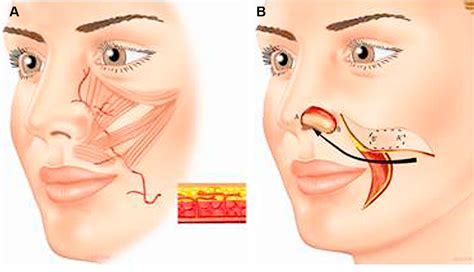 Figure 12 From Transposition Flaps In Nasal Reconstruction Semantic