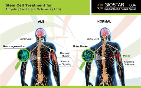 Stem Cell Therapy For Als Treatment For Als In India