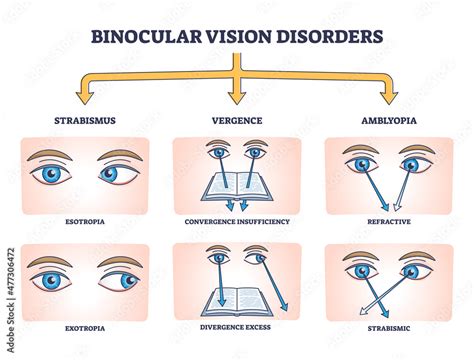 Fototapeta Kuchenna Binocular Vision Disorders With All Eye Defect