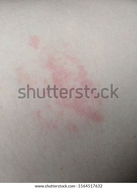 Skin Disease Red Rash Itching Groin Stockfoto 1564517632 Shutterstock