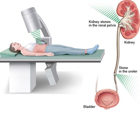 Treatment Options For Kidney Stones