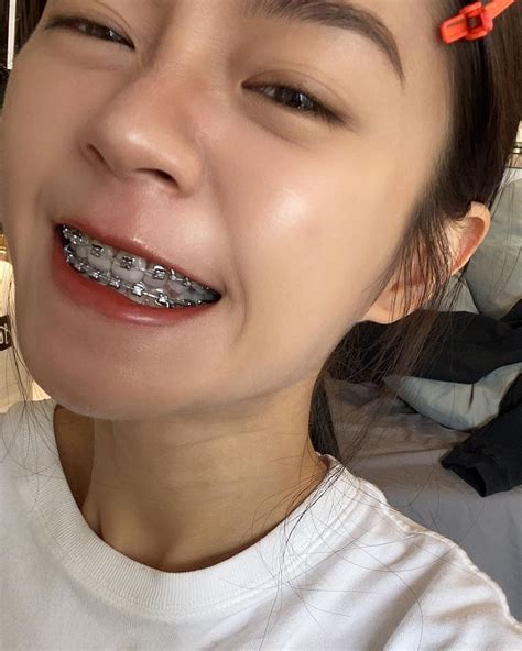 Tyta Styrn Girls With Braces