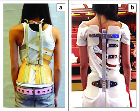 A Scoliosis Patient In A Milwaukee Brace And B Another In A Lyon