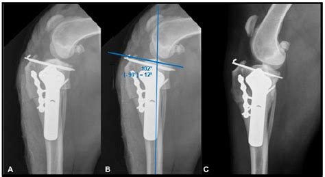 Scielo Brasil Double Plating Technique For Fixing Tibial Plateau