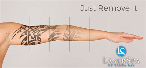 Laser Tattoo Removal Palm Harbor Laserspa Palm Harbor