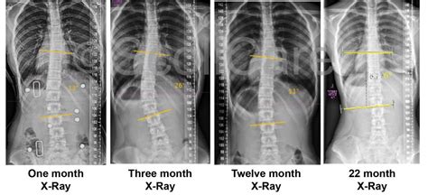 Scolibrace Archives Scoliosis Clinic Uk Treating Scoliosis Without