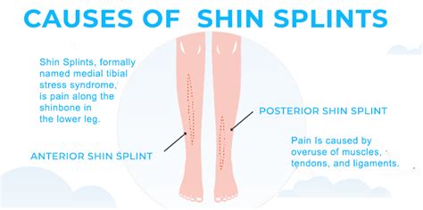 How To Heal Shin Splints Preventions Causes And Diagnosis