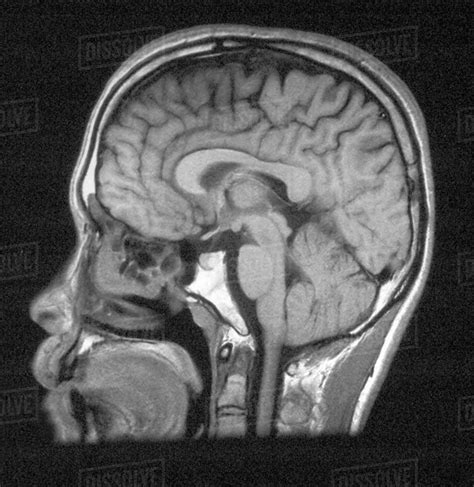 Mri Of Head Showing Normal Brain Structures Stock Photo Dissolve My