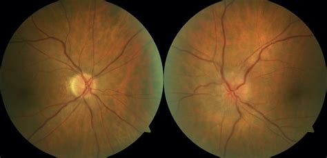 Optic Disc Photos Demonstrating A Normal Right Optic Nerve With A Small