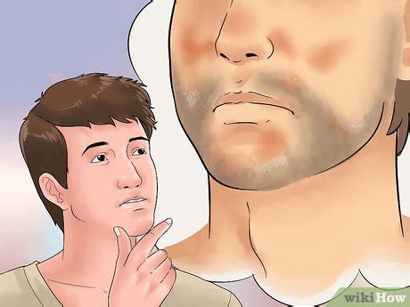 How To Treat Seborrheic Dermatitis On Your Face With Pictures
