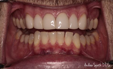 Refreshed Veneers Case Study General And Cosmetic Dentist In Newport