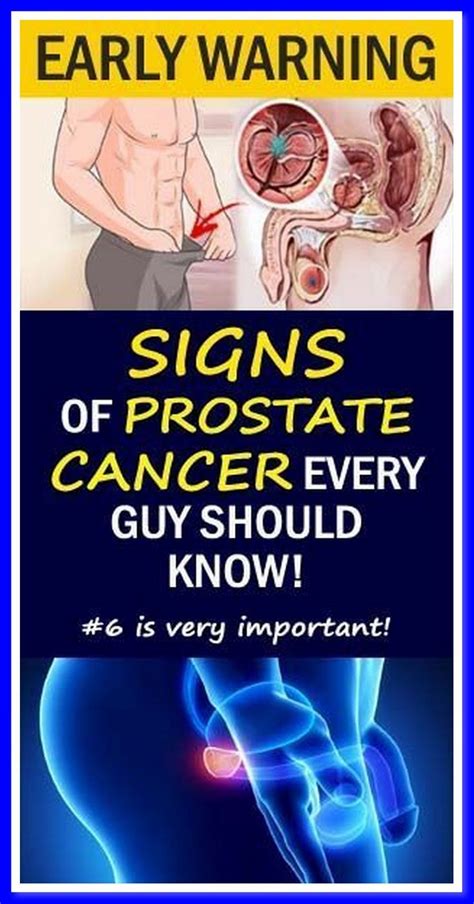12 Early Warning Signs Of Prostate Cancer That Every Guy Needs To Know Do Not Ignore Artofit