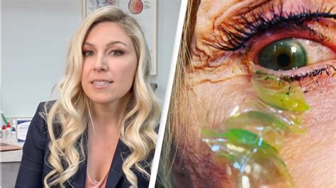 Doctor Who Removed 23 Contact Lenses From Patients Eye Has Never Seen Anything Like It