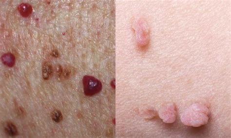 Raised Skin Bumps Pictures Types Causes And Treatment Images And