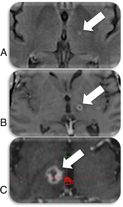 Pretherapeutic Resting State Fmri Profiles Are Associated With Mr